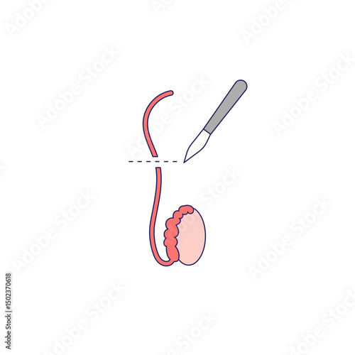 Vasectomy illustratrion