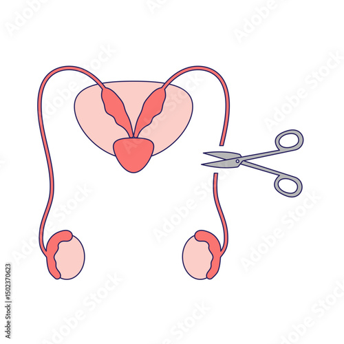 Vasectomy illustratrion