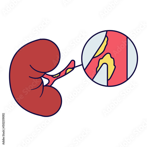 arthery disease
