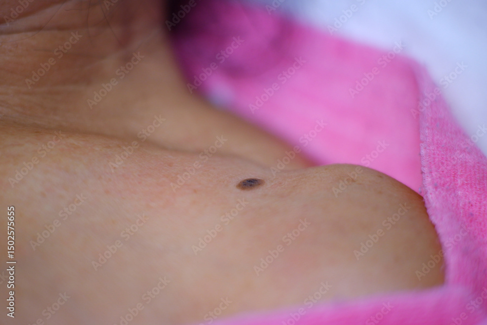 Fototapeta premium seborrheic keratosis or wart Shoulder and chest area