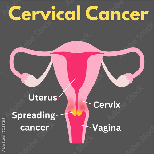 Cervical Cancer.eps