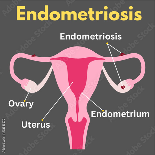 endometriosis uterus disease woman reproductive disease illustration useful for healthcare industry.eps