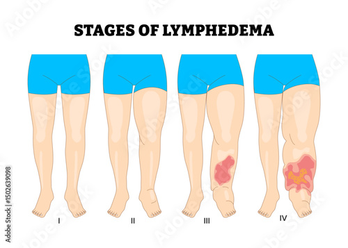 Stages of Lymphedema leg or foot stages process development process, educational medical poster design healthcare scheme, labeled swelling in the legs or feet, blocked lymphatic system fluid.