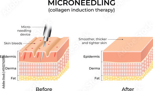 Microneedling procedure illustration showing skin layers before and after treatment. Design Vector Illustration