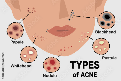 Facial Acne Types Illustration, Skincare Education, Dermatologist Reference, Medical Infographic