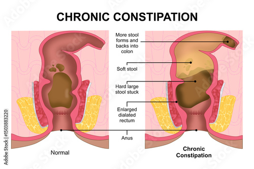 Chronic Constipation hard stool stuck illustration