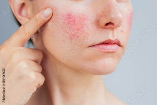 Young Caucasian woman suffering from rosacea on her face in the acute stage, she showing redness on her cheek. Skin chronic disease.