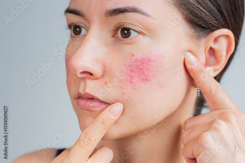 Foto Young Caucasian woman suffering from rosacea on her face in the acute stage