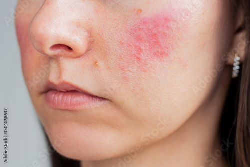 Young Caucasian woman suffering from rosacea on her face in the acute stage. Dermatological problems. Skin chronic disease