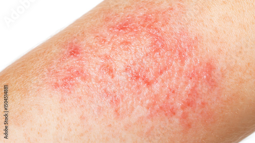 Skin rash: close-up image reveals inflammation and redness indicative of a skin condition. Healthcare, dermatology, and well-being implications.