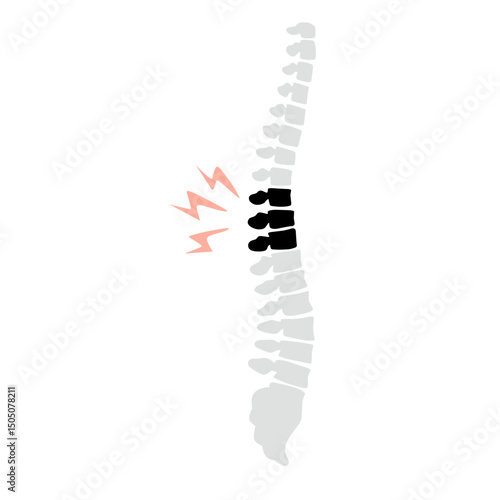 Spinal fracture vector illustration