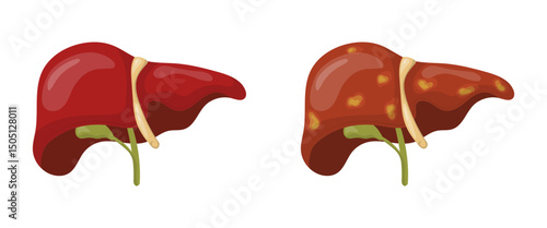 Healthy liver and fatty liver comparison representing cirrhosis or liver disease