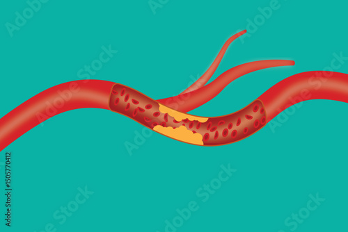 Clogged artery with cholesterol plaque and red blood cells, cardiovascular health issue.