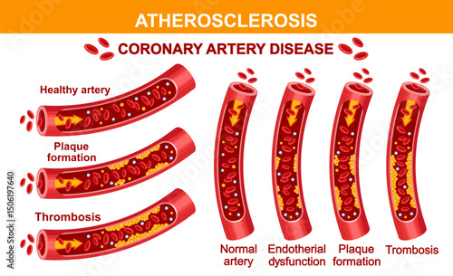 Atherosclerosis coronary artery disease, block arterial vessel cholesterol plaque, blood pressure, heart organ health. Cardiac cardiovascular system vascular thrombosis. Hypertension treatment. Vector