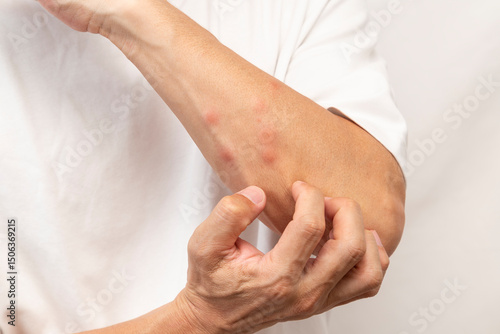 Photos 虫に刺された男性の腕