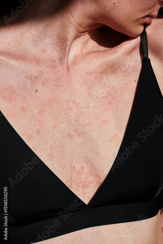 Close-up of woman skin affected by psoriasis. Eczema, rash and other skin diseases. Autoimmune genetic disease. Imperfect beauty.
