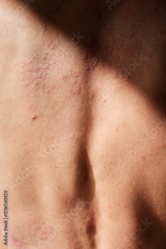Close-up of skin affected by psoriasis. Eczema, rash and other skin diseases. Autoimmune genetic disease. Imperfect beauty.