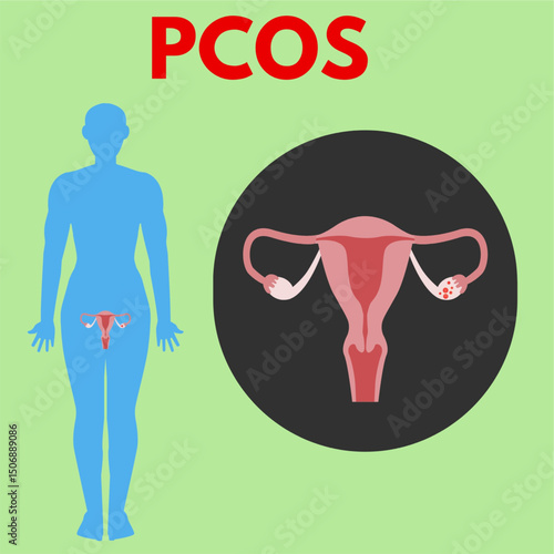 pcos zoom in from body uterus disease woman reproductive disease illustration useful for healthcare industry.eps