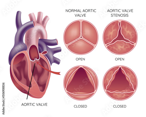 Medical illustration shows the difference between a normal aortic valve and one with stenosis, open and closed, and its location in the heart, with annotations