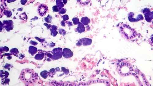 Mixed parotid tumor, light microscopy showing epithelial and myoepithelial cell components within chondromyxoid stroma, typical of pleomorphic adenoma.
