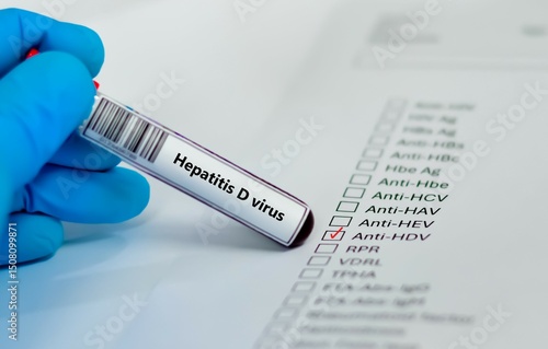 Blood sample tube for hepatitis D virus test analysis