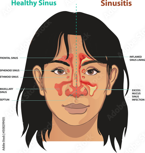 illustration of healthy sinus and sinusitis
