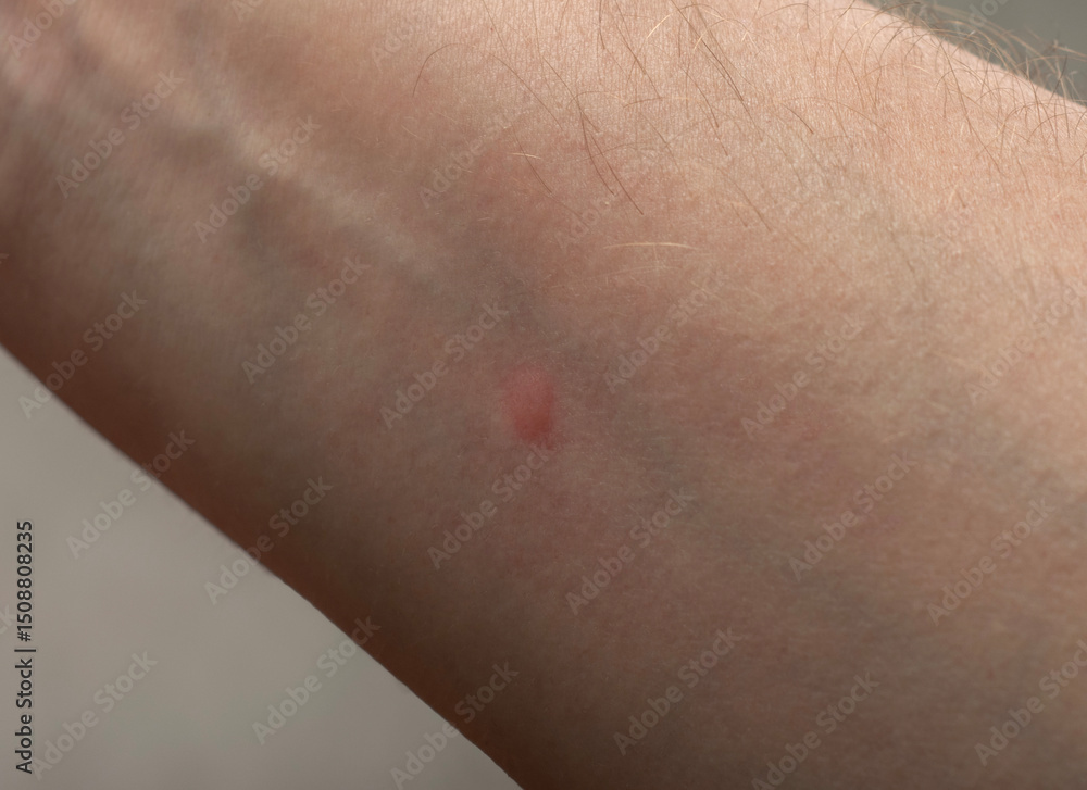 Fototapeta premium red spot on the hand from a mosquito bite