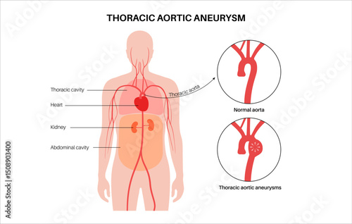Thoracic aortic aneurysm