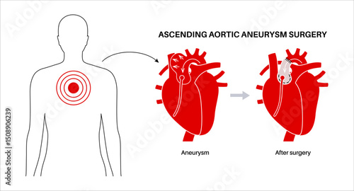 Thoracic aortic aneurysm open surgery