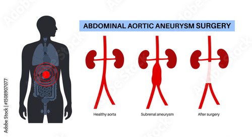 Abdominal Aortic Aneurysm