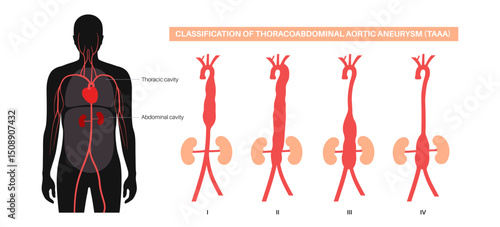 Thoracoabdominal aortic aneurysm