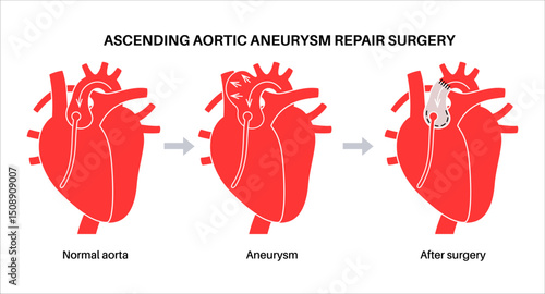 Thoracic aortic aneurysm open surgery