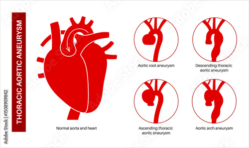 Thoracic aortic aneurysm