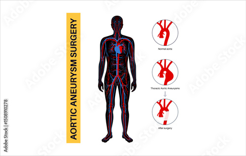 Thoracic aortic aneurysm open surgery