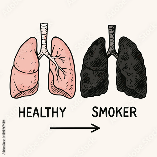 This vector image illustrates a comparison between healthy lungs and smoker's lungs, highlighting the impact of smoking. It serves as a visual tool for health education and smoking cessation...