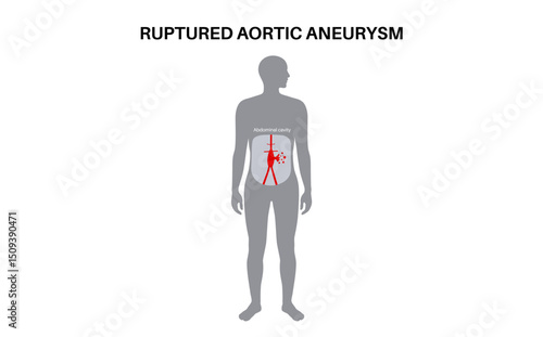Abdominal Aortic Aneurysm