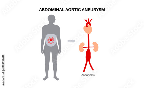 Abdominal Aortic Aneurysm