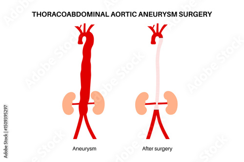 Thoracoabdominal aortic aneurysm surgery