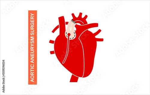 Thoracic aortic aneurysm open surgery