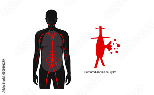 Abdominal Aortic Aneurysm