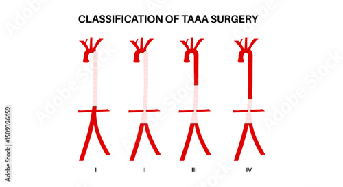 Thoracoabdominal aortic aneurysm surgery