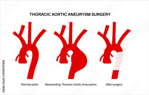 Thoracic aortic aneurysm open surgery