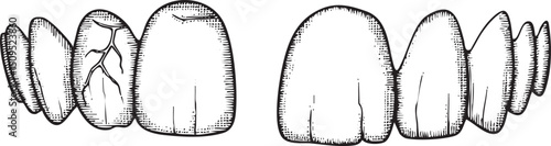 black and white depicts damaged teeth with cracks and fractures.