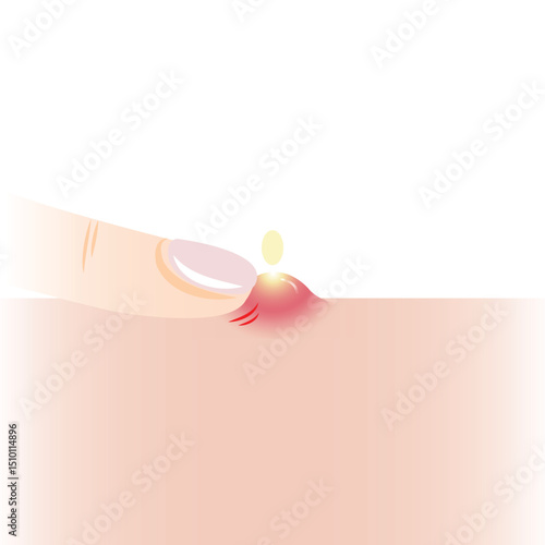 Infographic of squeeze inflammatory acne with one finger on skin vector illustration isolated on white background. Pustule on skin, squeezing, popping pimple. Skin care and beauty concept.