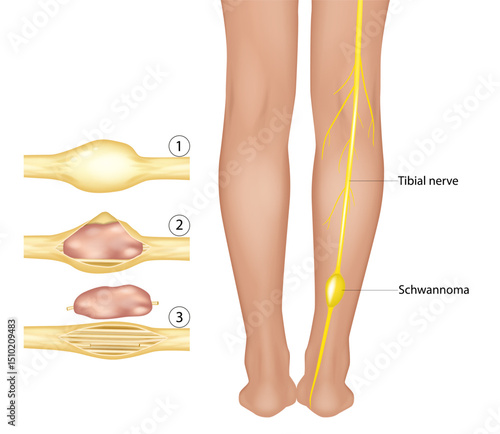 Tibial Nerve Tumor Anatomy. Peripheral Nerve Sheath Tumor in Leg. Schwannoma Medical Visualization. Detailed medical illustration showing the surgical removal of a benign tumor from a tibial nerve. 