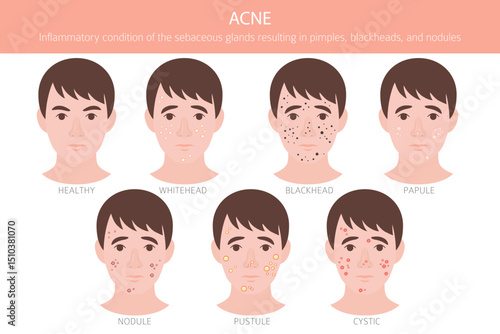 Acne skin condition. Skin diseases. Medical infographic design. Vector illustration