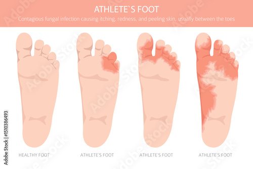 Athlete`s foot. Tinea pedis skin condition. Skin diseases. Medical infographic design. Vector illustration