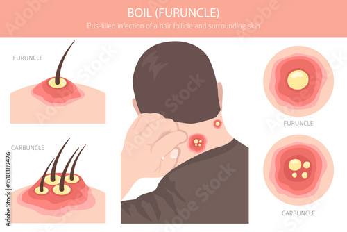 Boil, Furuncle, carbuncle. Skin diseases. Medical infographic design. Vector illustration