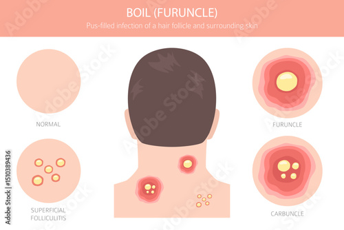 Boil, Furuncle, carbuncle. Skin diseases. Medical infographic design. Vector illustration