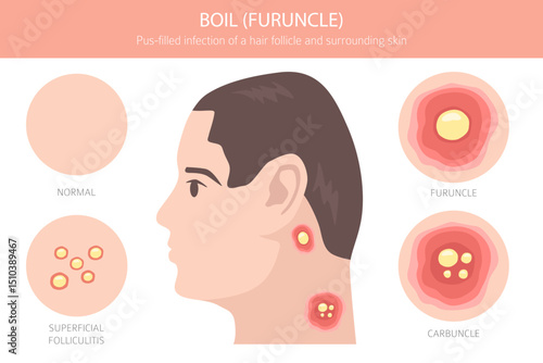 Boil, Furuncle, carbuncle. Skin diseases. Medical infographic design. Vector illustration